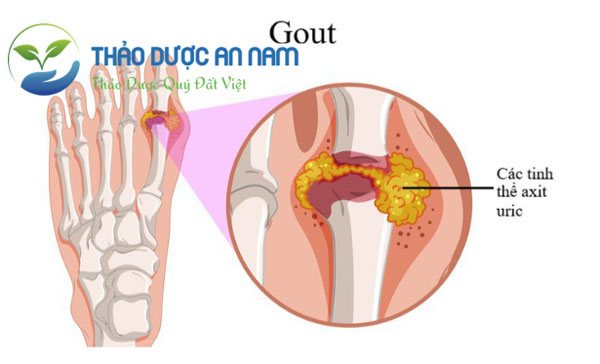 Chữa bệnh gout và đau nhức xương khớp